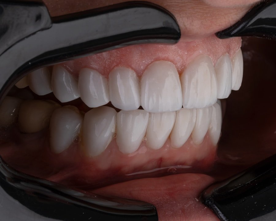 Smile makeover cosmetic dentistry results